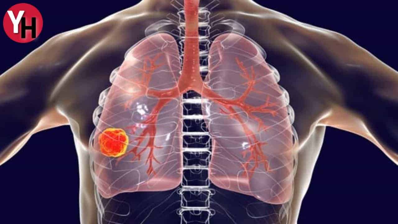 Adenokarsinom Nedir? Adenokarsinom Metastazı Ne Demek?