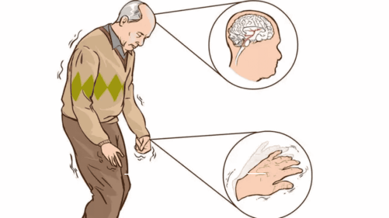 Parkinson Hastalığı Çağın Hastalığı