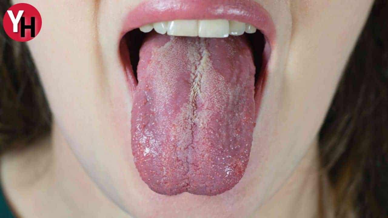 Candida Mantarı ve Günlük Yaşam