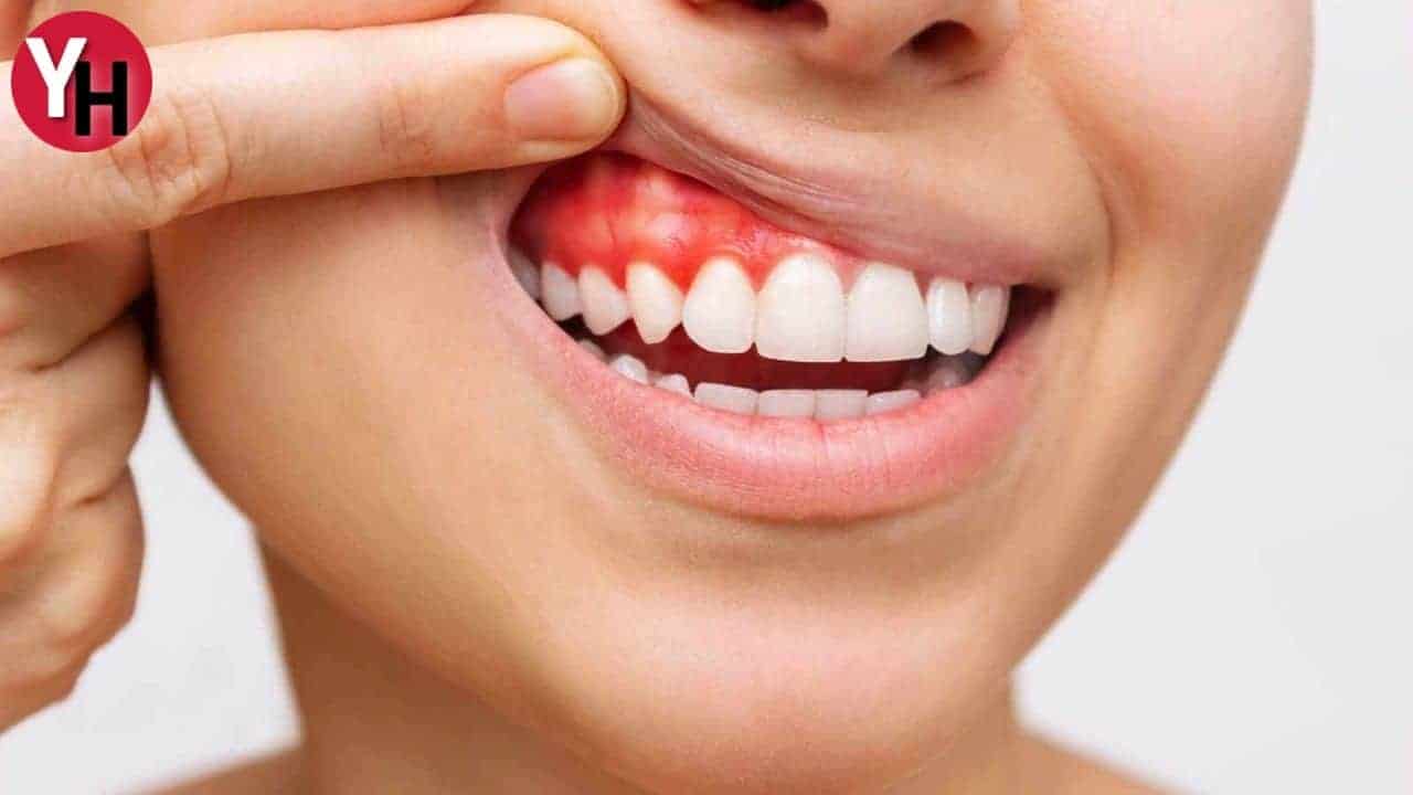 Diş Eti Kanaması ve Diş Eti İçin Homeopati