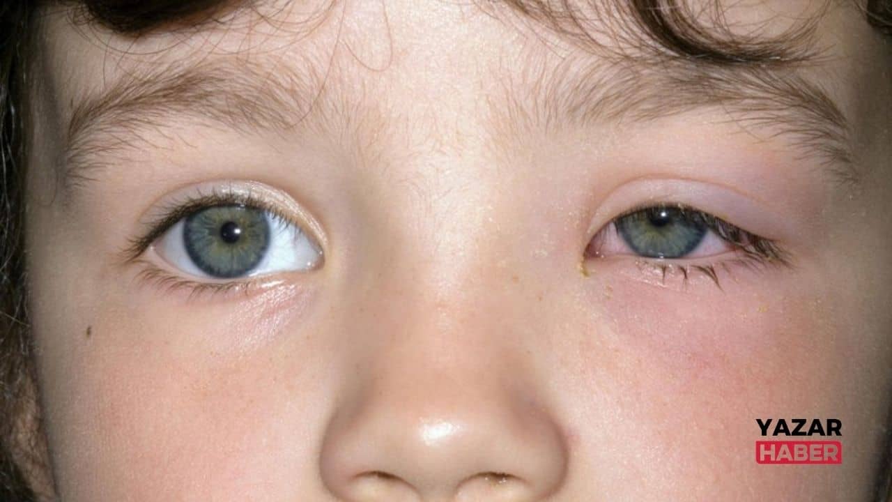 Çocuklarda göz kapağı şişmesi neden olur ve nasıl geçer? Çocukta göz kapağı şişmesi nasıl tedavi edilir