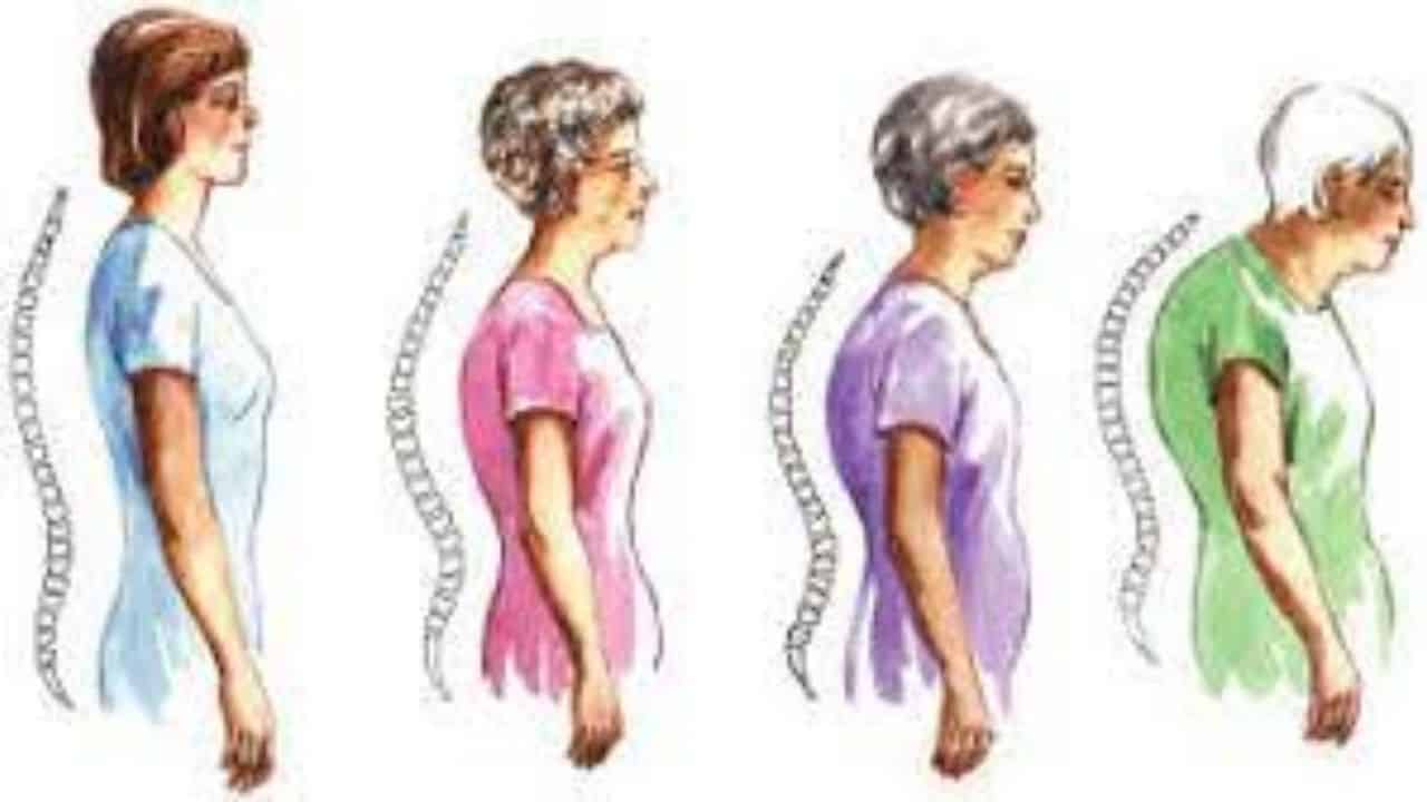 Kadınların Kemik Sağlığı: Osteoporozun Sessiz Tehlikesi ve Önleme Yolları”