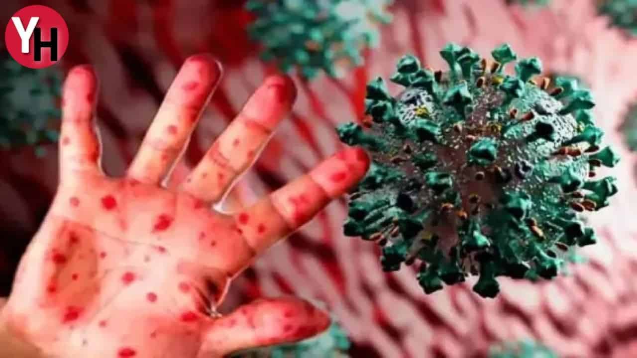 Maymun Çiçeği Virüsü ile İlgili Sağlık Bakanlığı’ndan Kritik Bilgilendirme