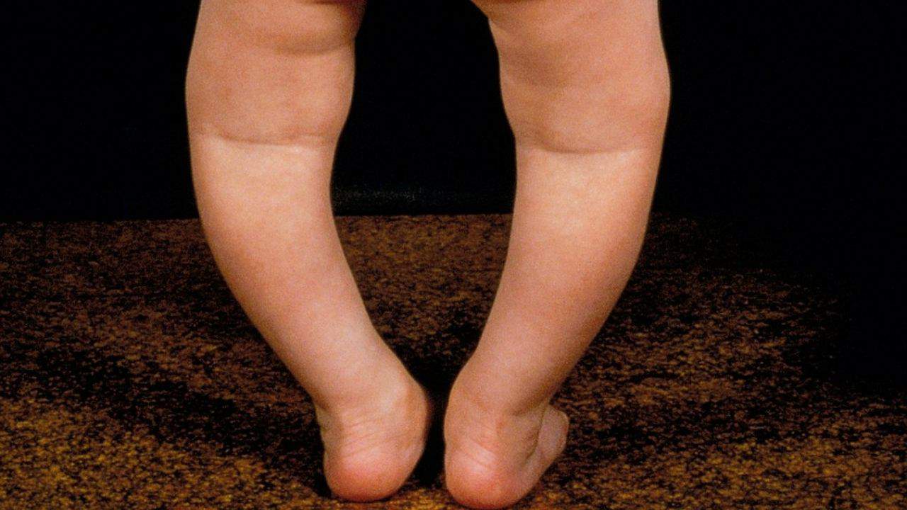 Raşitizm: D Vitamini Eksikliğinin Göz Ardı Edilmemesi Gereken Önemli Bir Sağlık Sorunu