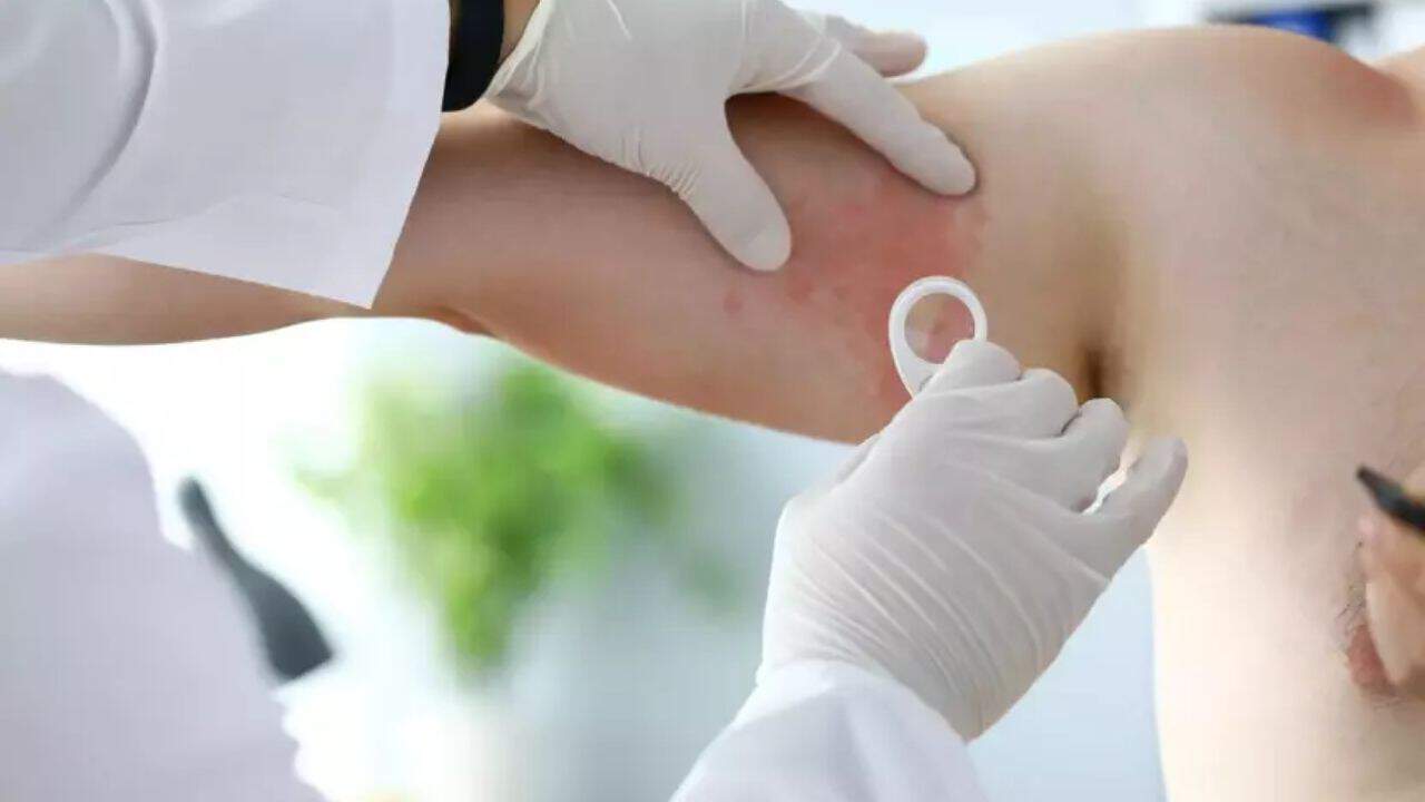 15 Dakikada Bulaşıyor: Kalabalık Alanlarda Uyuz Riskine Dikkat!