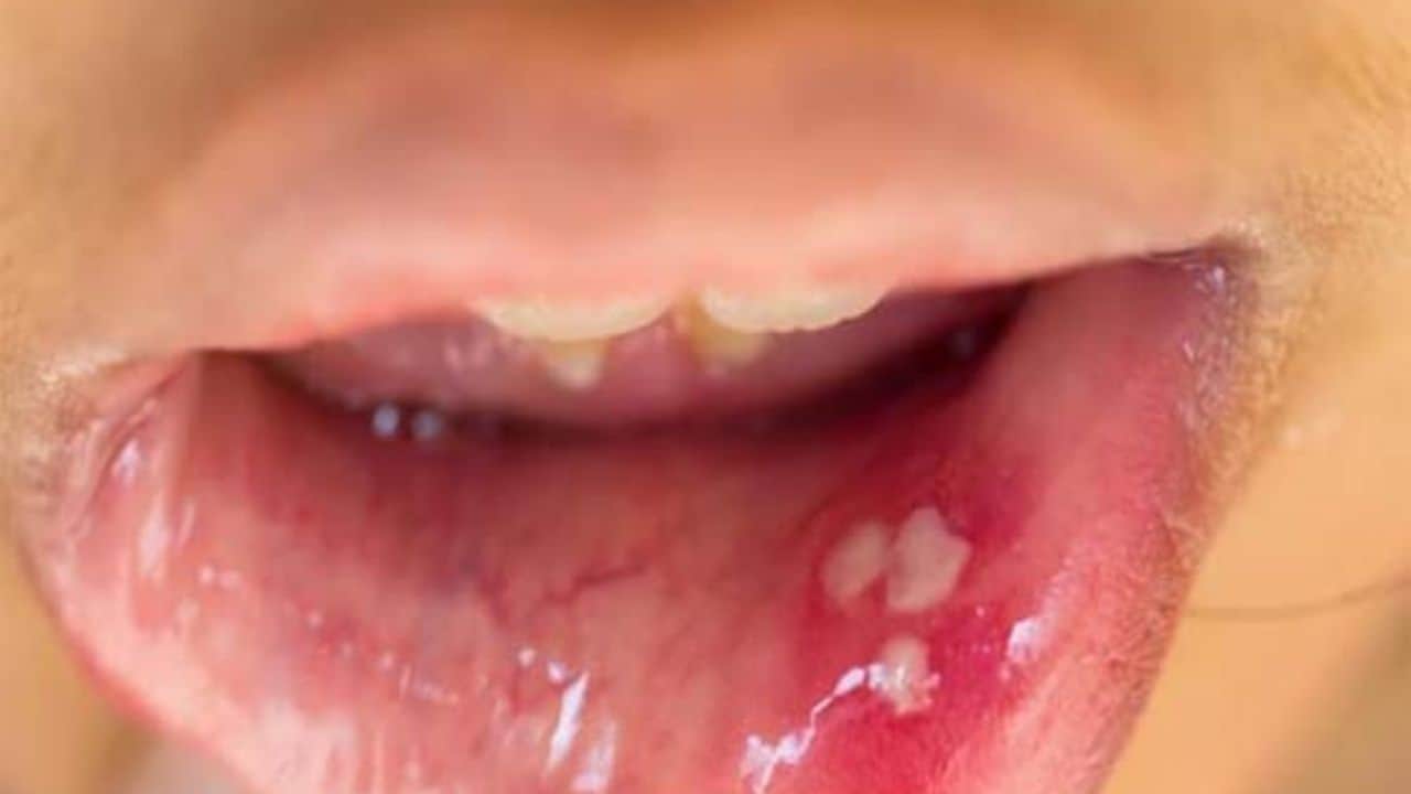 HPV Enfeksiyonu Nedir? Belirtileri ve Tehlikeleri?