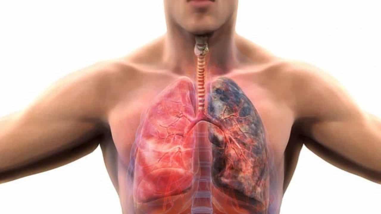 KOAH Nedir? Belirtileri, Nedenleri ve Tedavi Yöntemleri