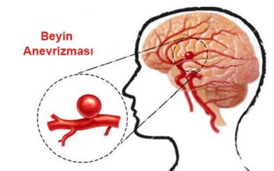 Beyin Anevrizması Nedir? Belirtileri, Nedenleri ve Tedavi Yöntemleri