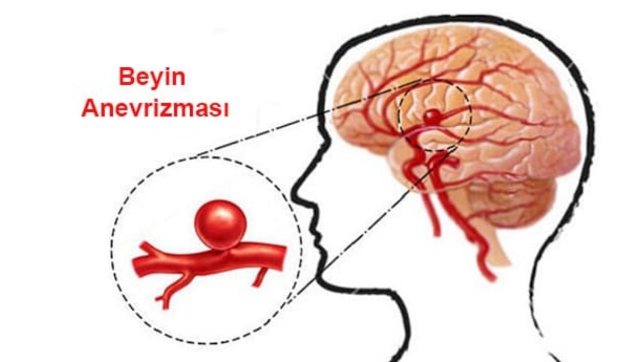 Beyin Anevrizması Nedir Belirtileri, Nedenleri ve Tedavi Yöntemleri