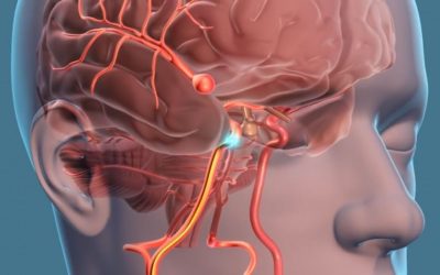 Beyinde Baloncuk Nedir? Belirtileri ve Tedavi Yöntemleri Nelerdir?