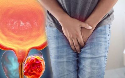 Prostat Kanseri Nedir? Belirtileri, Risk Faktörleri ve Tedavi Yöntemleri