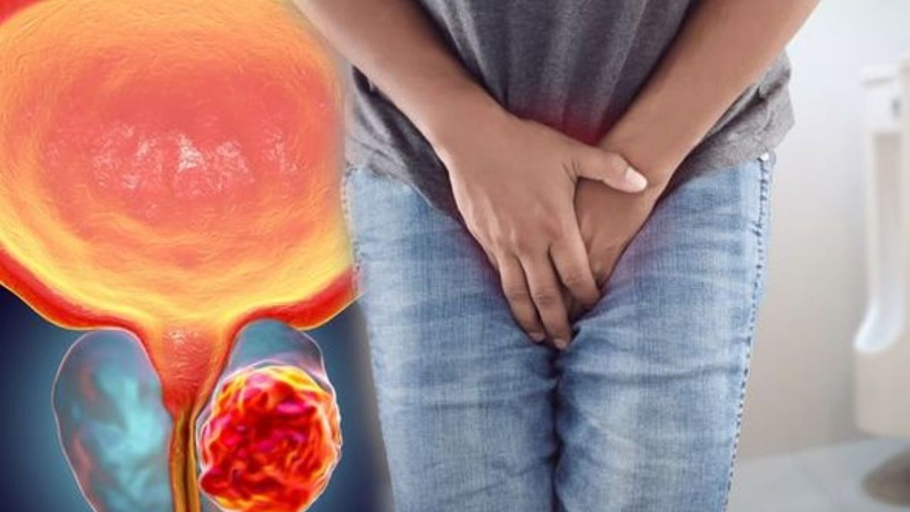 Prostat Kanseri Nedir Belirtileri, Risk Faktörleri ve Tedavi Yöntemleri