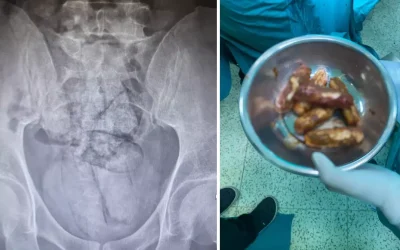 İranlı şüphelinin bağırsaklarından 350 gram uyuşturucu bulundu