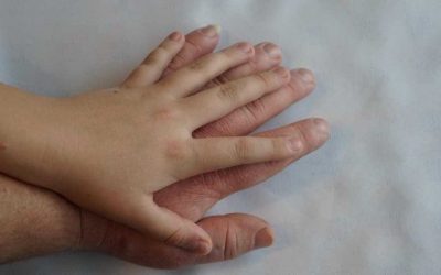 Akromegali: Nedir, Nedenleri, Belirtileri ve Tedavi Yöntemleri