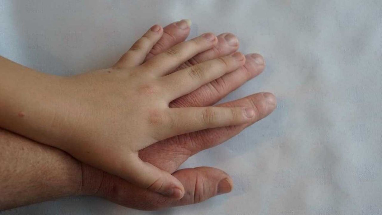 Akromegali Nedir, Nedenleri, Belirtileri ve Tedavi Yöntemleri