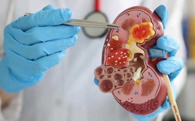 Böbrek Taşı: Neden Oluşur, Belirtileri Nelerdir ve Nasıl Tedavi Edilir?