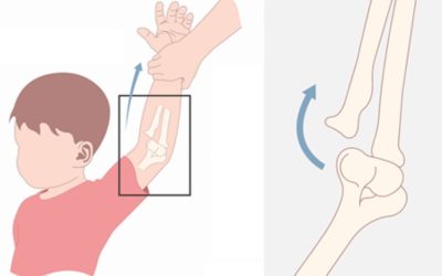 Dadı Dirseği: Nedir, Belirtileri, Tedavisi ve Önleme Yöntemleri