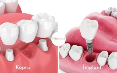 Diş İmplantı mı, Köprü mü? Karar Vermenize Yardımcı Olacak Bilgiler