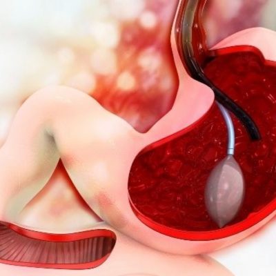 Geçici Çözüm mü Kalıcı Destek mi Mide Balonu Gerçekleri
