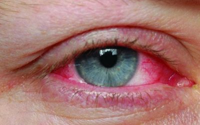 Konjonktivit (Göz Nezlesi): Nedenleri, Belirtileri ve Etkili Tedavi Yöntemleri