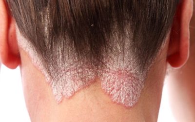Sedef Hastalığı (Psoriasis): Nedenleri, Belirtileri ve Tedavi Yöntemleri