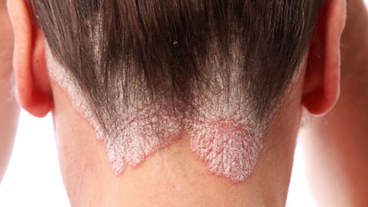Sedef Hastalığı (Psoriasis) Nedenleri, Belirtileri ve Tedavi Yöntemleri