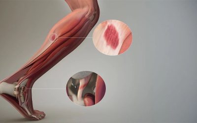 Yumuşak Doku Zedelenmesi: Tanım, Nedenleri, Belirtileri ve Tedavi Yöntemleri