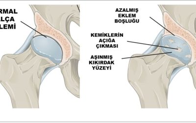 Kalça Kireçlenmesi Tedavisinde Fizik Tedavi Yöntemleri: Etkili Çözümler ve Uygulamalar