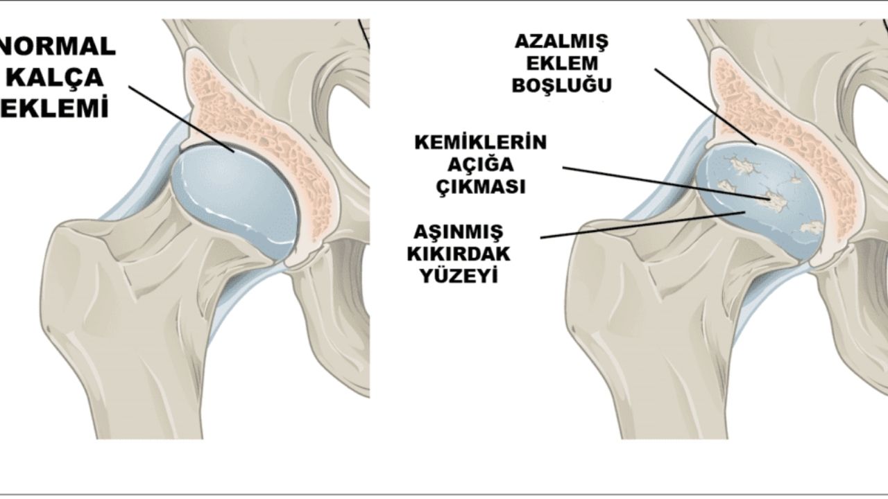 Kalça Kireçlenmesi Tedavisinde Fizik Tedavi Yöntemleri Etkili Çözümler ve Uygulamalar